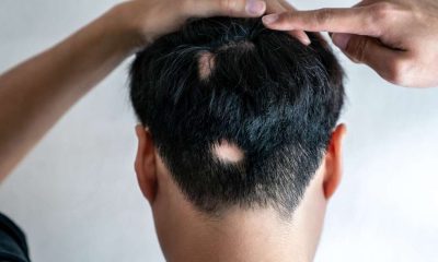 back of head with bald patches