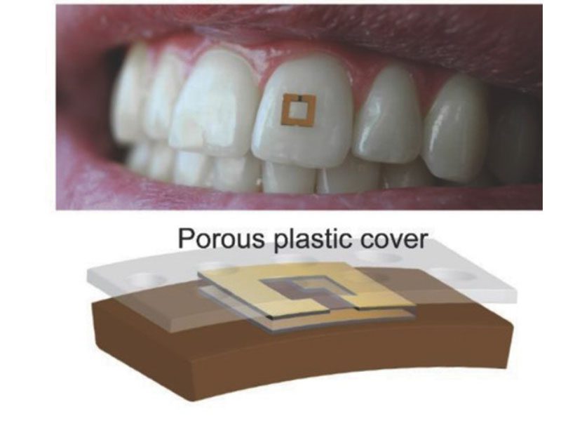 sensor on tooth